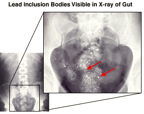 lead inclusion bodies in an xray of the gut